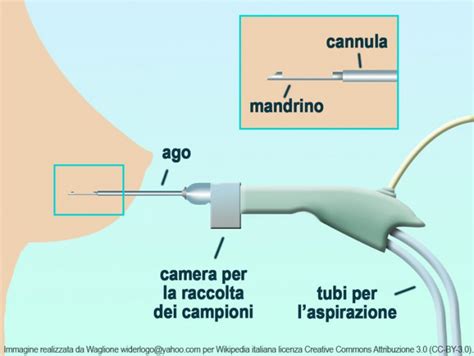 Mammotome cos è e a cosa serve l agobiopsia mammaria Quotidianpost