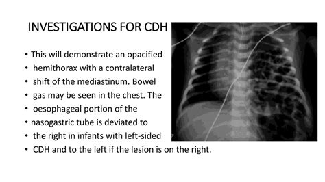 Congenital Diaphragmatic Hernia Ppt