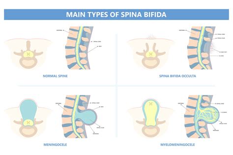 Spina Bifida In Babies Symptoms Diagnosis And Treatment Being The