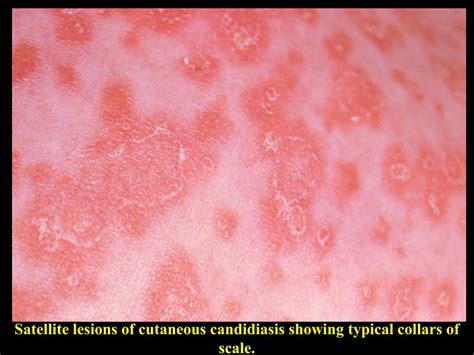 PPT Chronic Oral Candidiasis Of The Tongue And Mouth Corners Angular