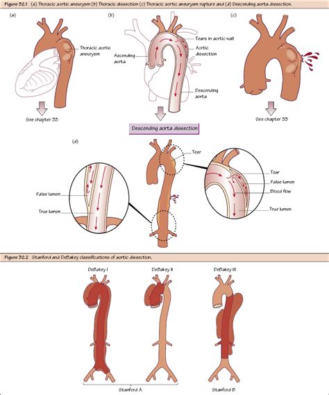 Thoracic Aortic Disease I Dissection Thoracic Key