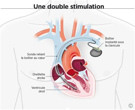 Des pacemakers toujours plus perfectionnés Sciencesetavenir fr