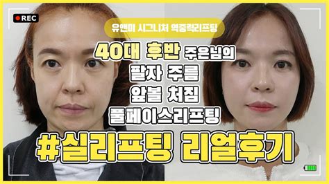 리얼후기 40대실리프팅 팔자주름리프팅 앞볼처짐리프팅 이중턱리프팅 실리프팅후기 Youtube