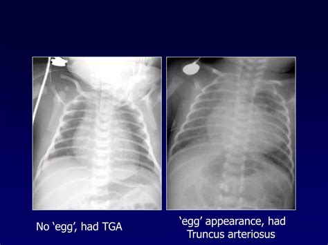 Approach To Cyanotic Congenital Heart Disease Ppt