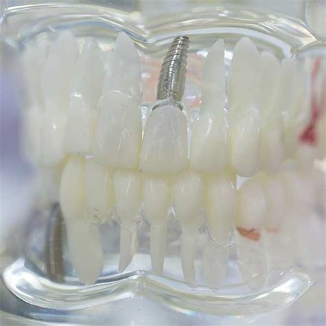 Best Dental Implant Clinic Near Me - VIP Dental Implants