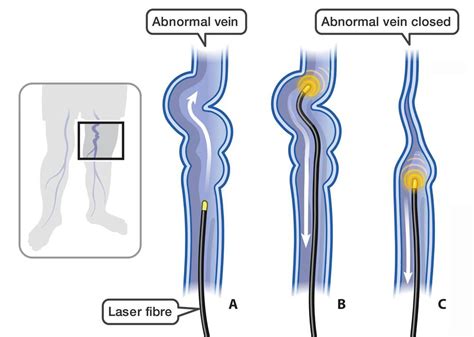 Evlt Nm Medical Laser Machine Endovenous Ablation Varicose Veins