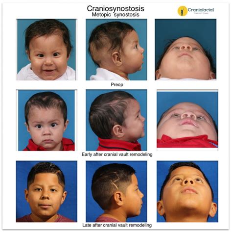 Craniosynostosis Gallery Dell Childrens Craniofacial Team Of Texas