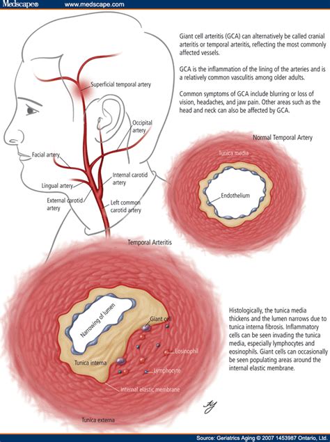 Giant Cell Arteritis An Update On Diagnosis And Management