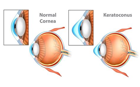 THE INS AND OUTS OF KERATOCONUS - Davis Eyecare