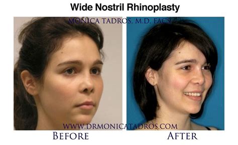 Flared Nostrils Rhinoplasty Before And After Canvas Broseph