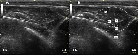 Ultrasound Guided Femoral And Obturator Nerves Block In The Psoas