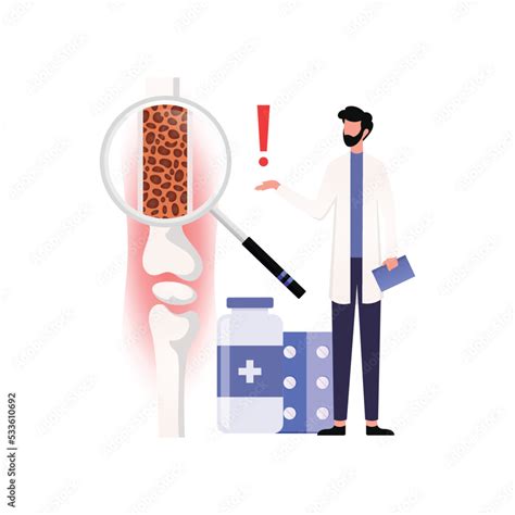 Medical Diagram Of Deep Vein Thrombosis At Leg Area Illustration About