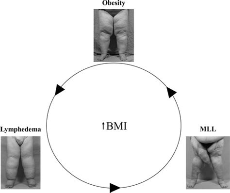 Lymphedema Obesity