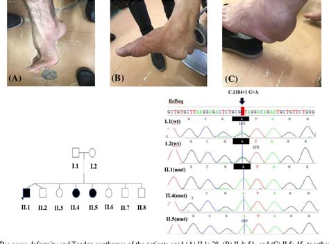 Figure From Clinical And Genetic Characteristics Of Splicing Variant