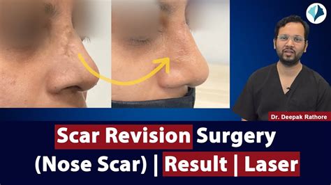 Scar Revision Surgery Nose Scar Before After Result Of Nose Scar