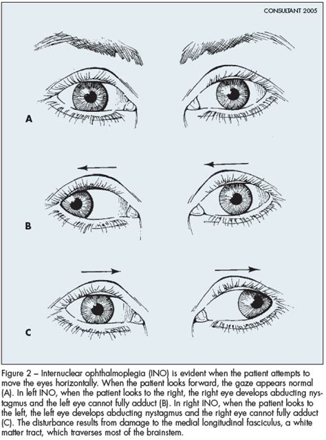 Multiple Sclerosis: When to Suspect—Keys to Diagnosis | Consultant360