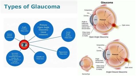 Glaucoma Ppt