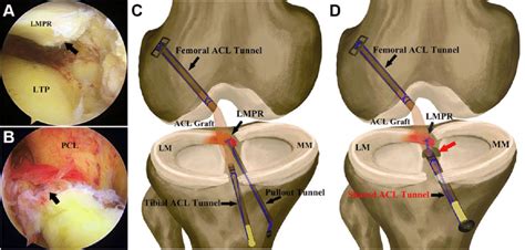 Diagnosed Acl Injury With Lmpr Tear Under Arthroscopy And Schematic