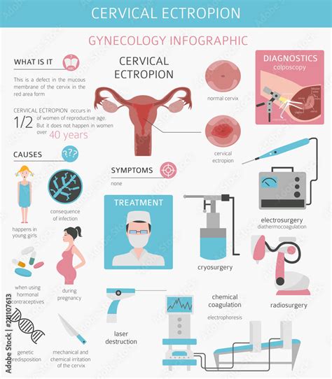 Cervical ectropion. Ginecological medical desease infographic Stock Vector | Adobe Stock