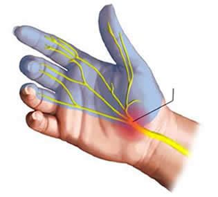 Conociendo M S Del S Ndrome De T Nel Carpiano S Ntomas Y Tratamiento
