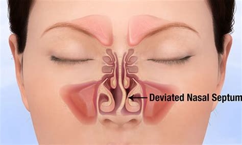 Deviated Nasal Septum Understanding Causes Symptoms And Treatment