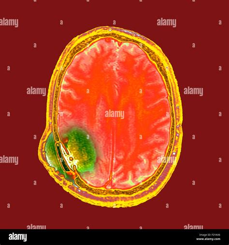 Brain Cancer After Surgery Coloured Magnetic Resonance Imaging Mri