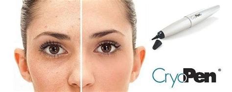 Cryopen Cryotherapy New Revolutionary Pain Free And Safe Skin