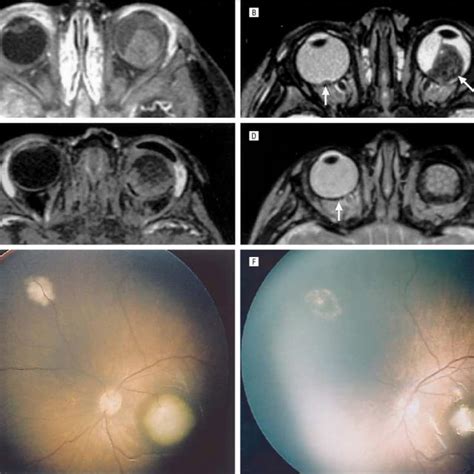 Pre Treatment And Post Treatment Appearance Of Retinoblastoma Rb