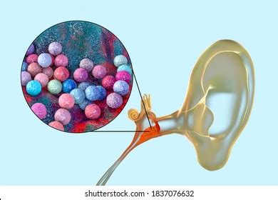 Otitis Media Caused By Bacteria Staphylococcus Stock Illustration