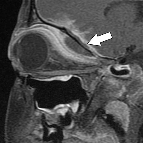 Subperiosteal Abscess