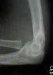 Radial Head Fracture Wheeless Textbook Of Orthopaedics