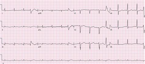 Electrocardiography Showed Inferior Wall Myocardial Infarction Sinus