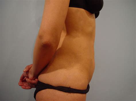 Liposuzione Liposcultura Chirurgia Estetica Pisa Dott Cecchini