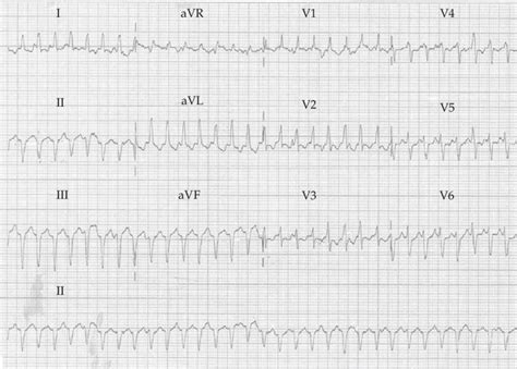 Monomorphic wide QRS complex tachycardia with a pattern of right bundle ...