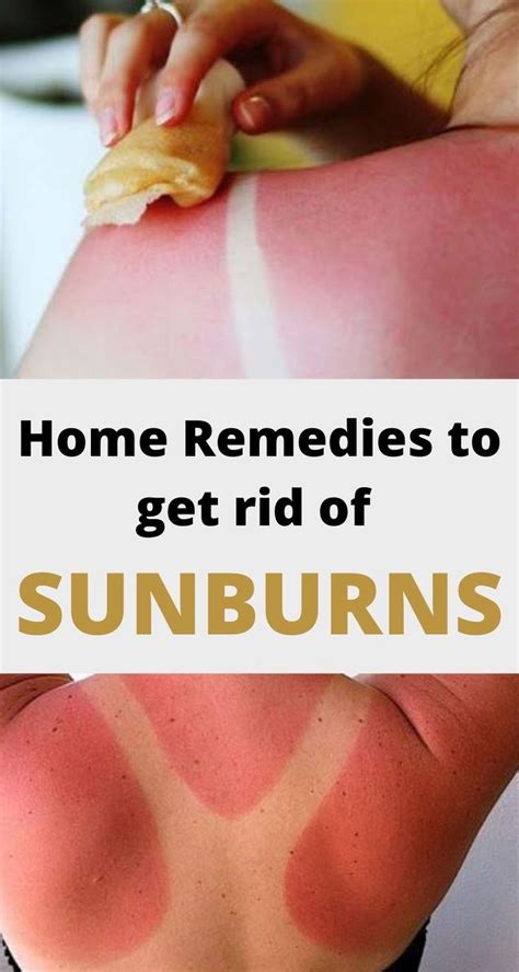 How To Get Rid Of Sunburns Fast With Home Remedies And Treatments Get Rid Of Sunburn Sunburn