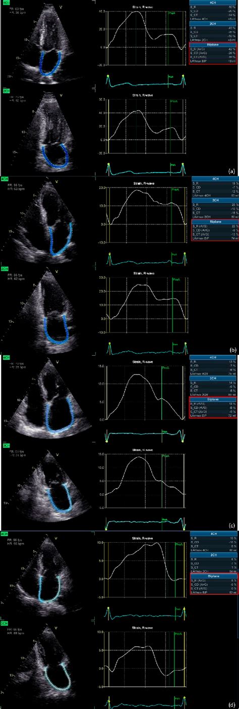 Figure 1 From Value Of Left Atrial Strain In Predicting Recurrence