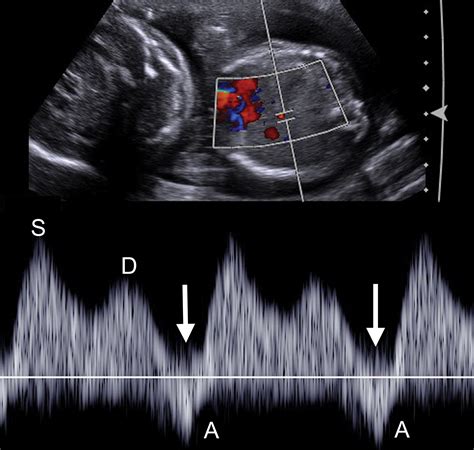 A Radiologists Guide To The Performance And Interpretation Of Obstetric Doppler Us Radiographics