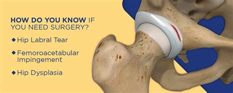 What to Expect From Your Hip Arthroscopy Surgery