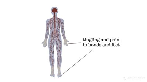 Polyneuropathy Understand Recognise And Treat Alpine Biomedical