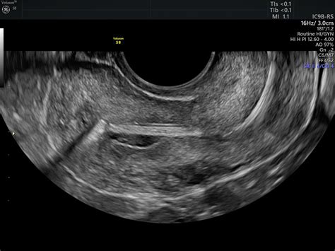 Navigating Copper Iud Placement And The Use Of Ultrasound Empowered