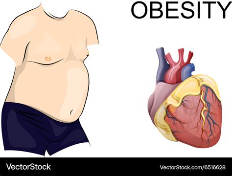 Obesity Body And Heart Royalty Free Vector Image