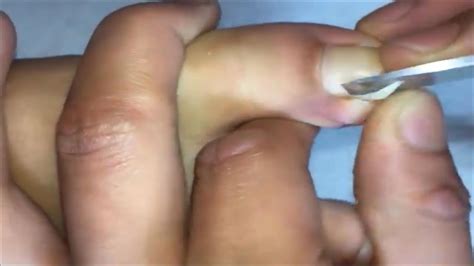 Worst Ingrown Toenails Nail Treatment 8 Youtube