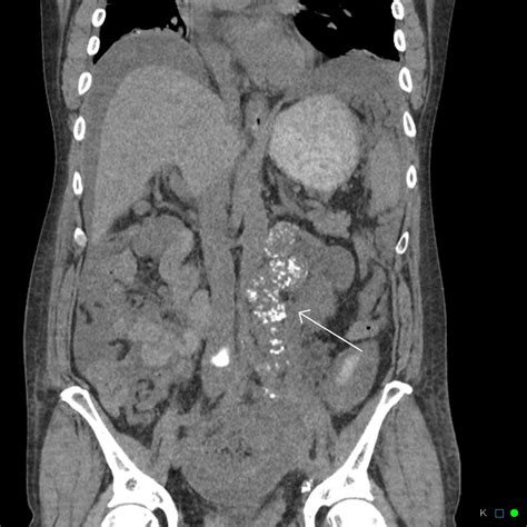 Metastatic Mucinous Adenocarcinoma Of The Colon With Calcification