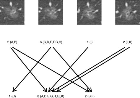 Measurement Of Focal Ground Glass Opacity Diameters On Ct Images Interobserver Agreement In