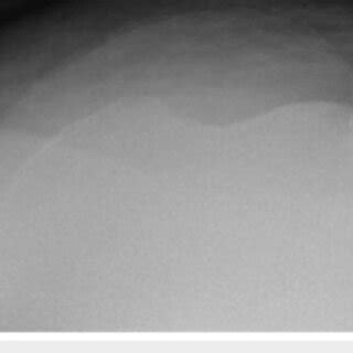 Modified sunrise (patient unable to bend knee) radiograph of left knee ...