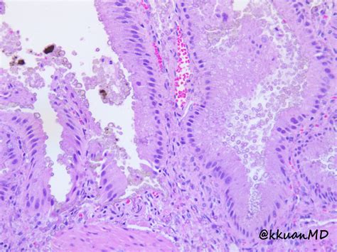 Jerad Gardner Md On Twitter Rt Kkuanmd Gallbladder Specimen