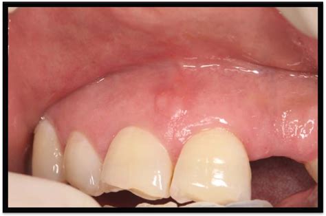 Hpv On Gums