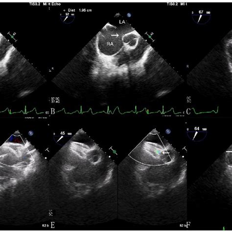 Using Transthoracic Echo During The Procedure Subcostal View Showing