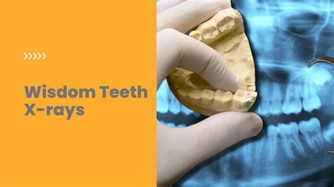 Wisdom Teeth X-Rays: Why They’re So Important | Reveal Diagnostics