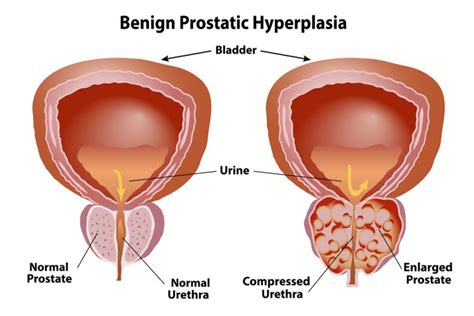 Penyakit Benign Prostatic Hyperplasia BPH Gejala Penyebab